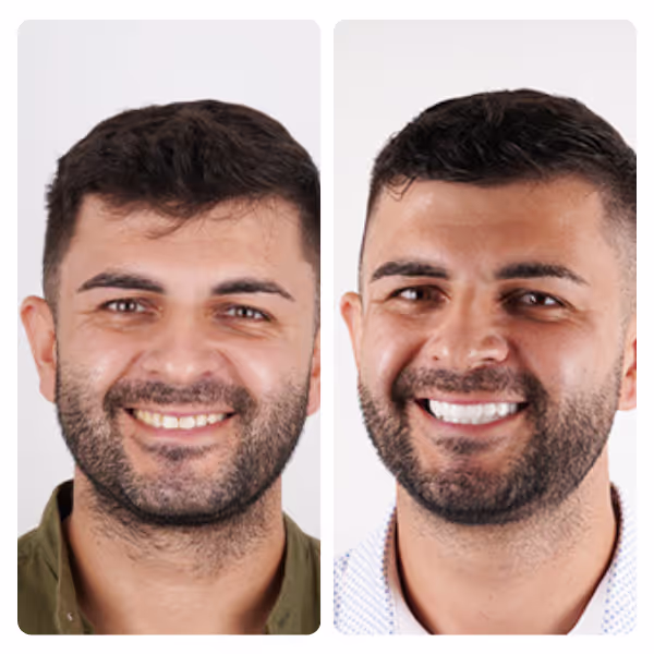 Hollywood Smile in Turkey